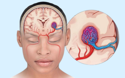 Cerebral Arteriovenous Malformation
