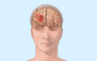 Subdural Hemorrhage 