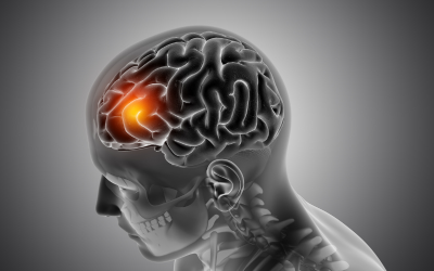 Cerebral Venous Thrombosis