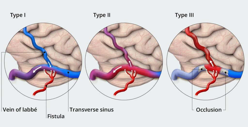 Arteriovenous Fistula – Expert IR Neuro Vascular Clinic | Endovascular ...