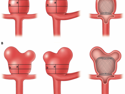 Web-Device-in-cerebral-Aneurysm